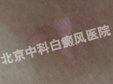 白癜风医院